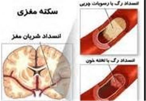 سکته مغزی، سومین علت مرگ و میر در ایران